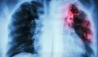 Imagen Esto es todo lo que debes de saber acerca de la tuberculosis; checa sus síntomas 