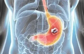 Imagen AstraZeneca presenta dos ensayos con avances prometedores en el cáncer de mama y gástrico