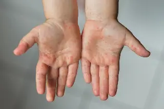 Imagen Virus coxsackie: Síntomas y cómo tratar la enfermedad