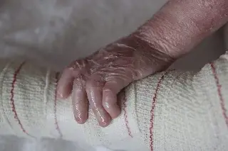 Imagen Injertos de modificados genéticamente; esperanza para pacientes con 'piel de mariposa'