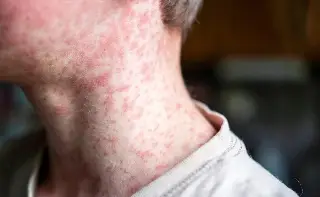 Imagen Conoce un poco acerca del sarampión y cuáles son sus síntomas 