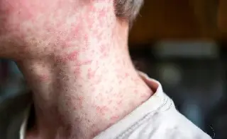 Conoce un poco acerca del sarampión y cuáles son sus síntomas 
