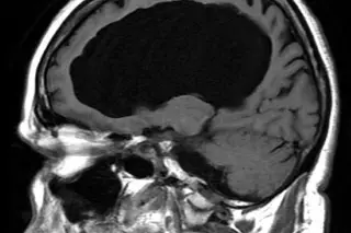 Infartos cerebrales impactan a mexicanos cada vez más jóvenes, alertan