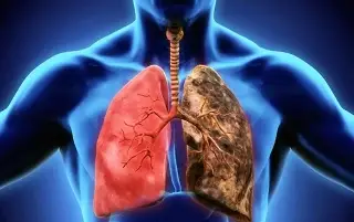 Imagen Estudio asocia el consumo de alimentos ultraprocesados a mayor riesgo de cáncer de pulmón
