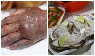 Imagen Se disparan infecciones de bacteria ‘come carne’ en Luisiana; suman 6 muertos