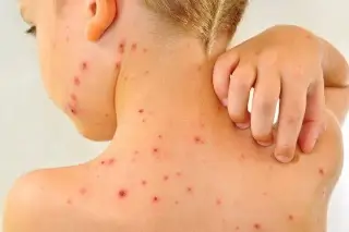 Imagen Vacunación contra sarampión se rezagó por pandemia: Salud