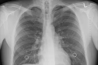 Imagen Diagnóstico temprano del cáncer de pulmón sube considerablemente la supervivencia: experta