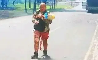 Imagen Recibe injertos en manos, piernas y cabeza menor protegida por su abuelita en explosión de pipa