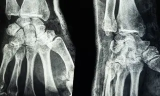 Científicos crean material  para tratamiento de fracturas y reparación rápida; de esto trata