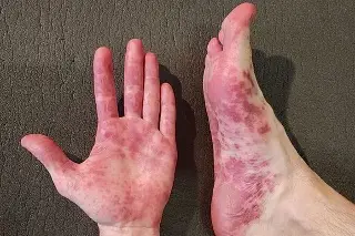 ¿El virus Coxsackie puede afectar a los adultos? 