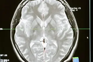 Crean células capaces de eliminar uno de los peores tumores cerebrales 