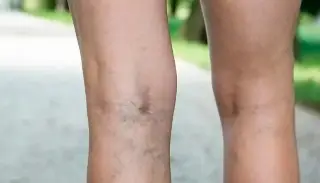 ¿Qué son las várices, qué las provoca y cómo pueden prevenirse? 