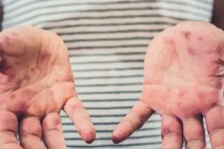 Detectan 71 casos de virus Coxsackie en escuelas de Veracruz 