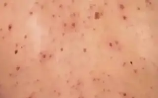 Muere bebé de un año por sarampión en Tlaxcala ¿Estaba vacunado?