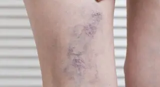 ¿Tienes várices? Esta información te puede servir 