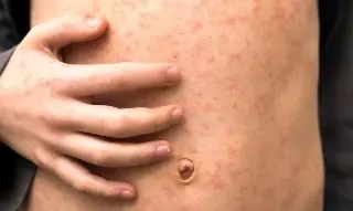 Confirman primera muerte por sarampión en Chiapas; suman 29 defunciones en México  