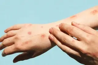 California registra aumento de contagios de la viruela del mono y urge la vacunación