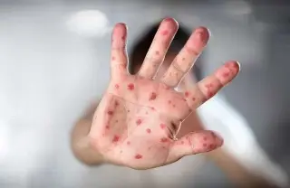 Sarampión reaparece en Veracruz. Estos casos reportan hasta 2026