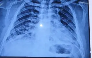 Acusan que IMSS niega atención a paciente con Síndrome de Down que padece neumonía