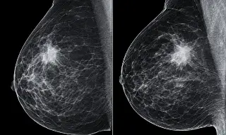 Claves para la detección oportuna del cáncer de mama: Lo que debes saber 
